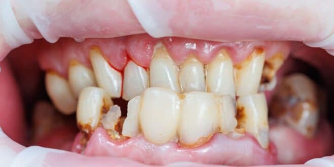 Alerte santé: une mauvaise hygiène dentaire peut avoir un impact sur votre libido
