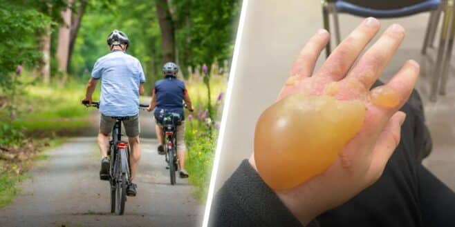 Il fait une randonnée à vélo et se retrouve avec une ampoule à la main à cause d'une plante